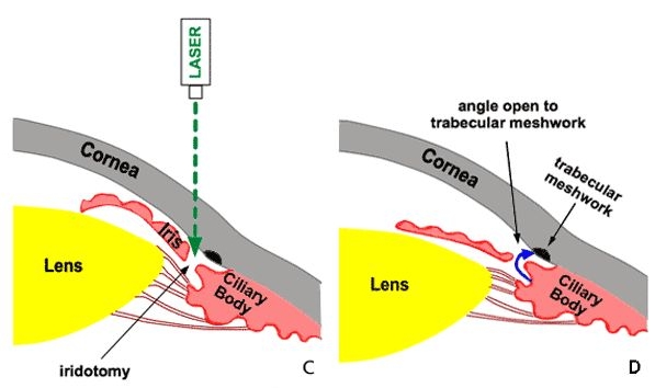  Iridotomia YAG-LASER