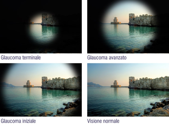 come vede paziente glaucomatoso